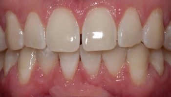 Teeth after chairside bleaching treatment, visibly whiter and brighter.