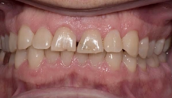 Before and after comparison of zirconia dental crowns.