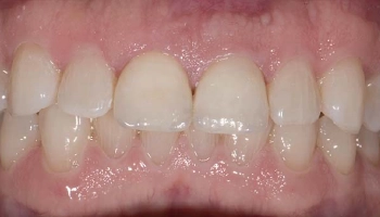 After: Smile transformation with porcelain layered zirconia crowns.