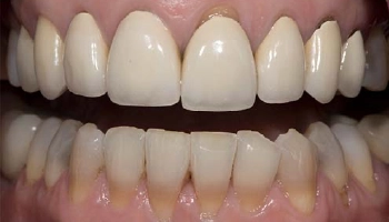 Side-by-side comparison of dental crowns before and after treatment.