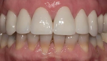 Before and after images of porcelain layered zirconia crowns.