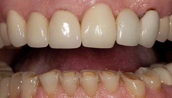 Before and after comparison of monolithic zirconia crowns.
