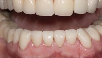 After image of a patient’s smile with monolithic zirconia crowns.
