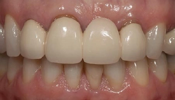 Before and after images of dental bridge and crown restoration.