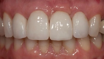 Before and after of dental bridge, implant, and crowns.