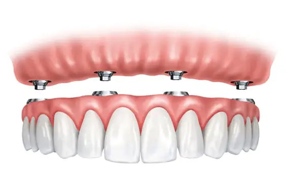 Implant-Supported Dentures